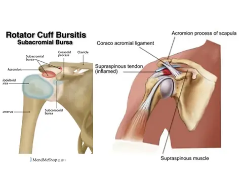 rotator cuff bursitis